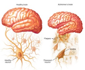 阿尔茨海默（AD）