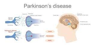 帕金森病（PD）