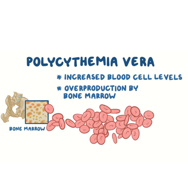 真性红细胞增多症（PV）