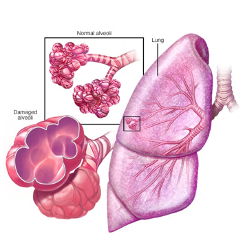 慢性阻塞性肺病（COPD）
