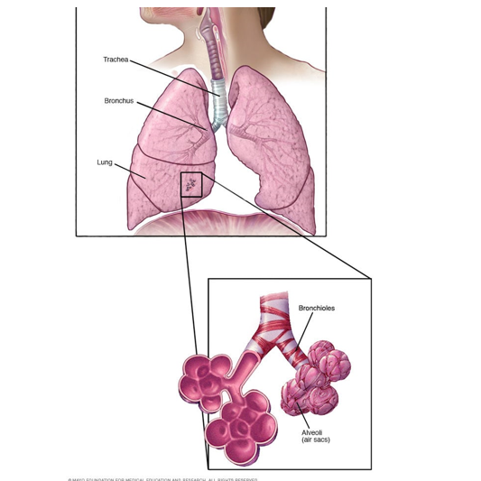 间质性肺病（ILD）