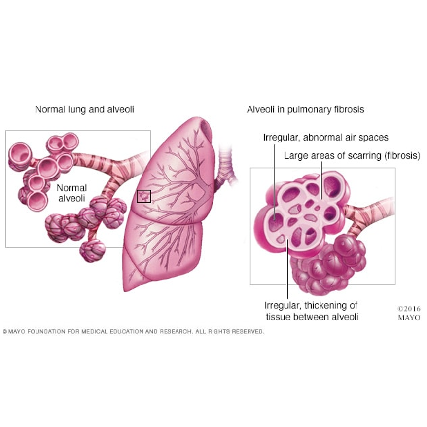 肺纤维化（PF）