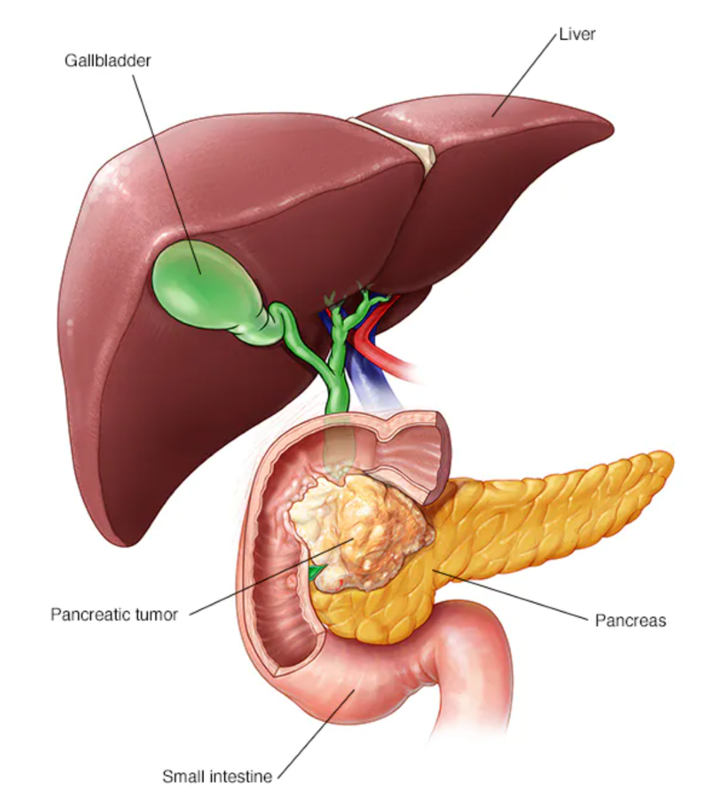 胰腺癌 （Pancreatic Cancer)