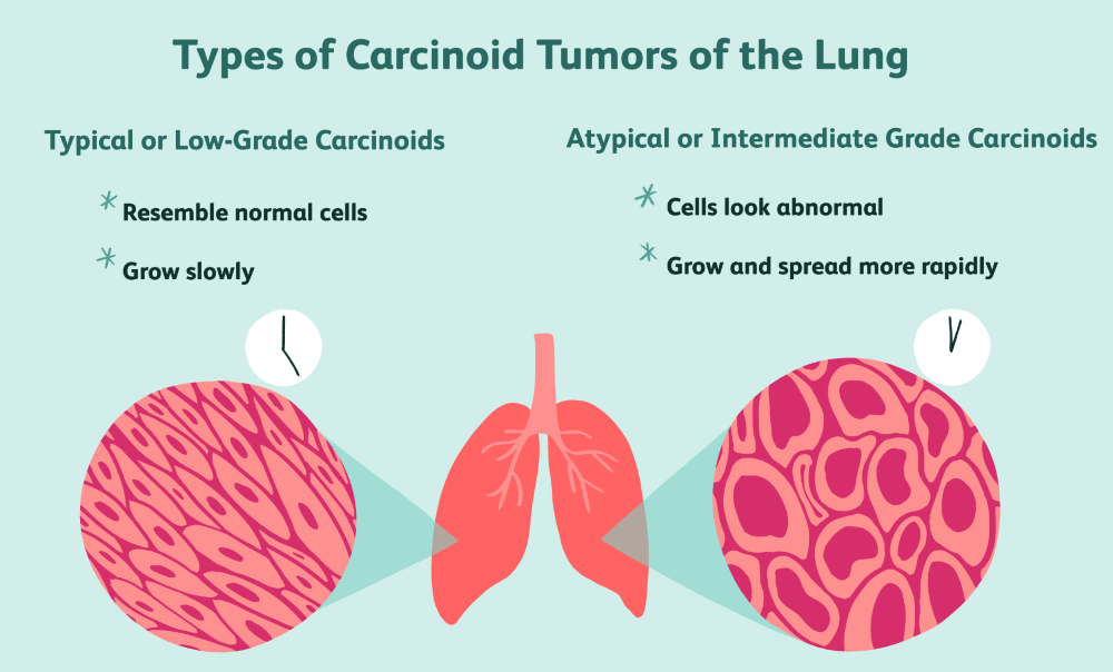 肺类癌 （Lung Carcinoid Tumor)