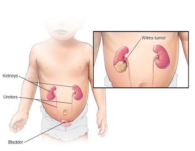 肾母细胞瘤 (Wilms Tumor)