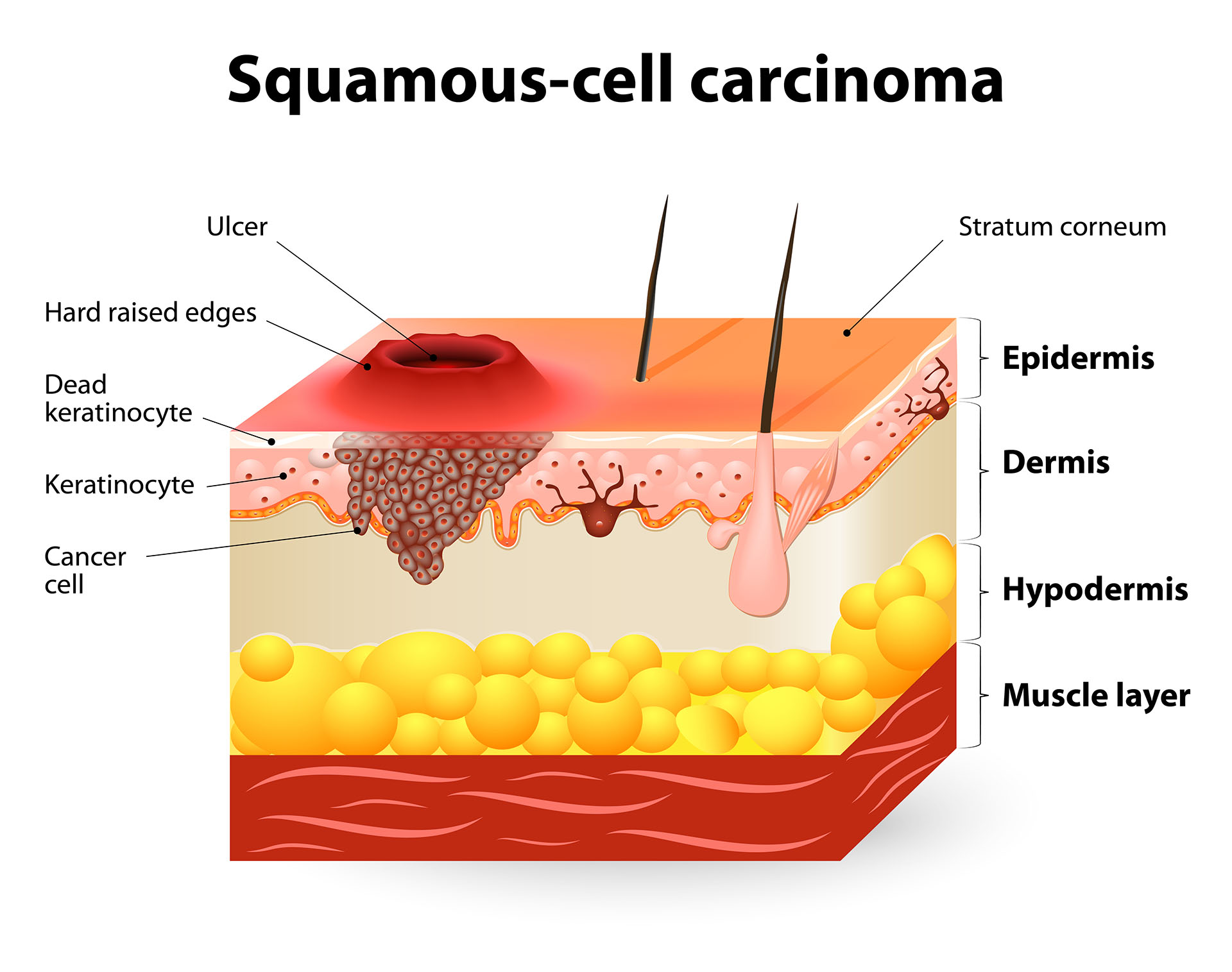 基底细胞和鳞状细胞皮肤癌