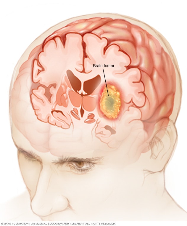 成人脑和脊髓肿瘤