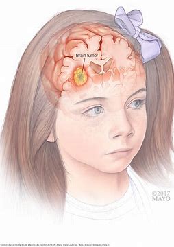 儿童脑和脊髓肿瘤