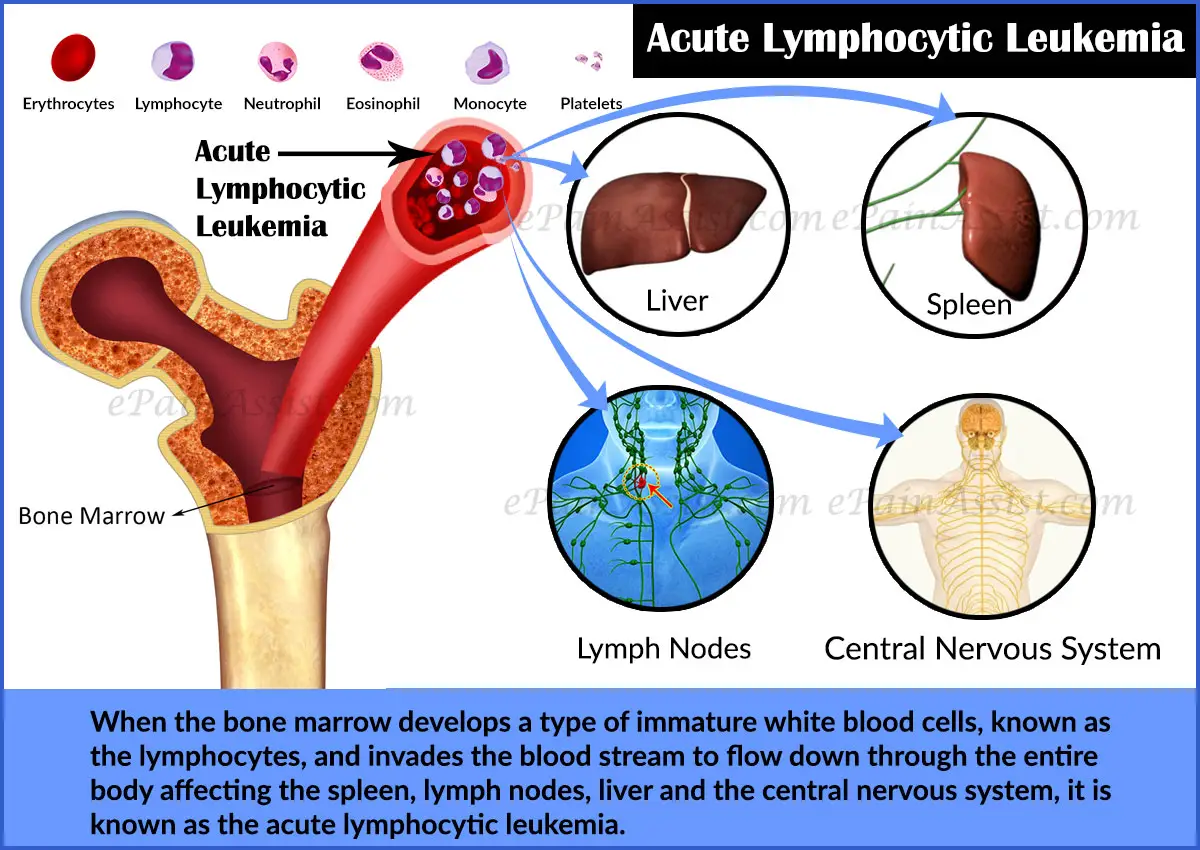 成人急性淋巴细胞白血病 （ALL)