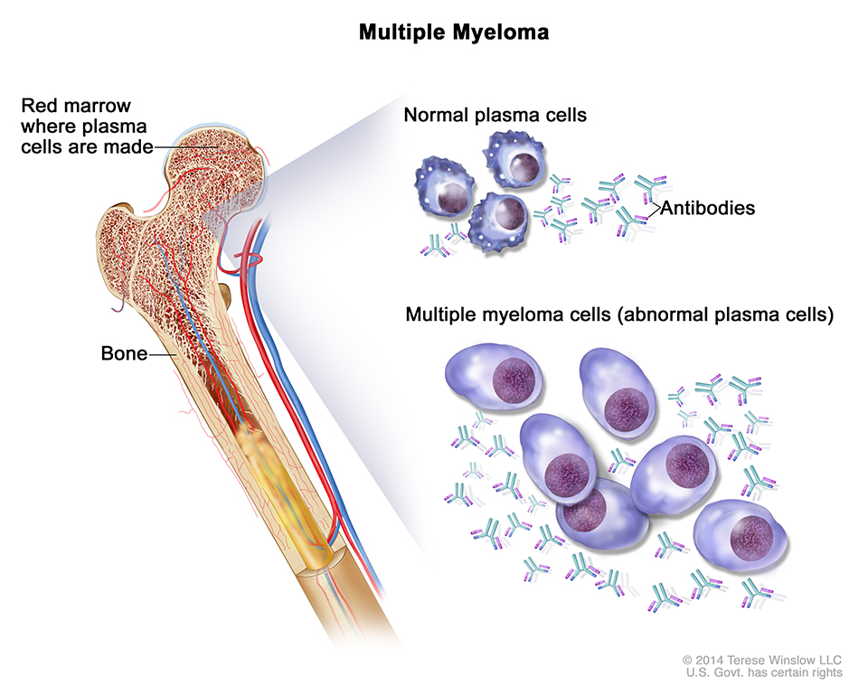 多发性骨髓瘤 （MM)