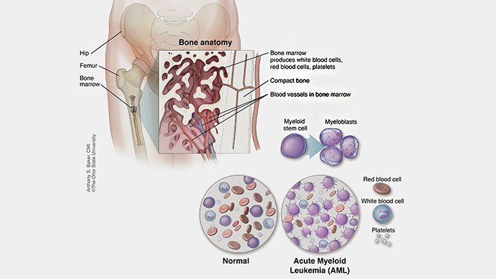 成人急性髓细胞白血病 （AML）