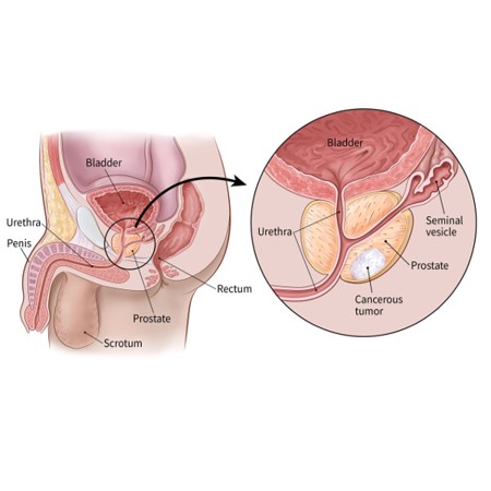 前列腺癌