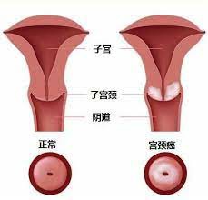 巴替利单抗（balstilimab、AGEN2034）用于转移性宫颈癌患者