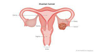 Botensilimab加巴替利单抗（balstilimab、AGEN2034）对R/R卵巢癌产生持久反应