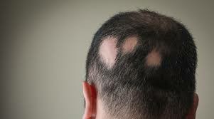 欧盟委员会批准辉瑞的利特昔替尼（Ritlecitinib）-LITFULO用于青少年和成人重度斑秃