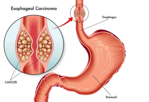 食管癌 （Esophageal Cancer）