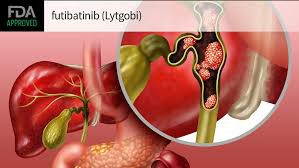 福巴替尼（futibatinib）治疗肝内胆管癌的疗效