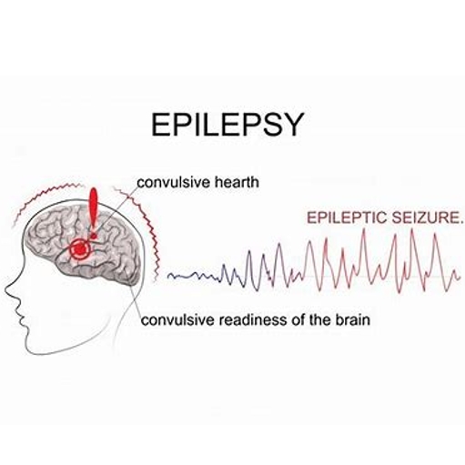 癫痫（Epilepsy）