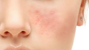 Cabtreo（adapalene,benzoyl peroxide and clindamycin phosphate）的注意事项有哪些