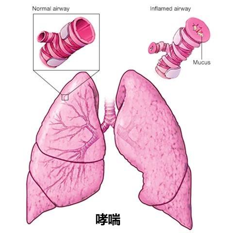 哮喘（asthma）