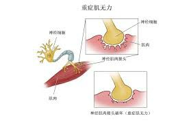Zilbrysq（zilucoplan）在哪能买到