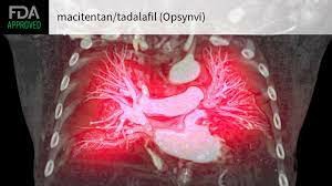 Opsynvi（Macitentan and Tadalafil）是什么药