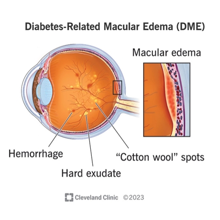 糖尿病性黄斑水肿(DME)