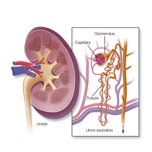 狼疮性肾炎（LN）