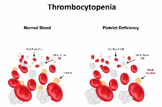 确诊血小板减少症能活几年