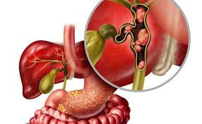 晚期胆管癌的生存期预测与影响因素探讨