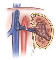 肾癌可以治愈吗？