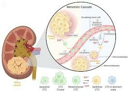 肾癌最佳治疗方案是什么？