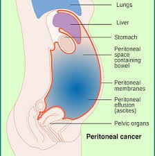 腹膜癌能活多久？