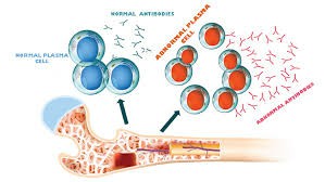 白血病早期的8个征兆