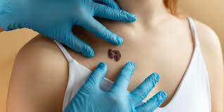 默克尔细胞瘤能够治愈吗？