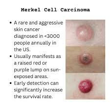 默克尔细胞瘤是属于什么类型癌症？