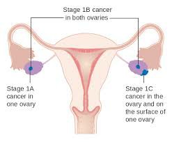 卵巢癌是怎样分期的？