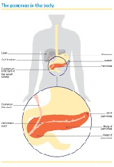 胰腺癌怎么引起的